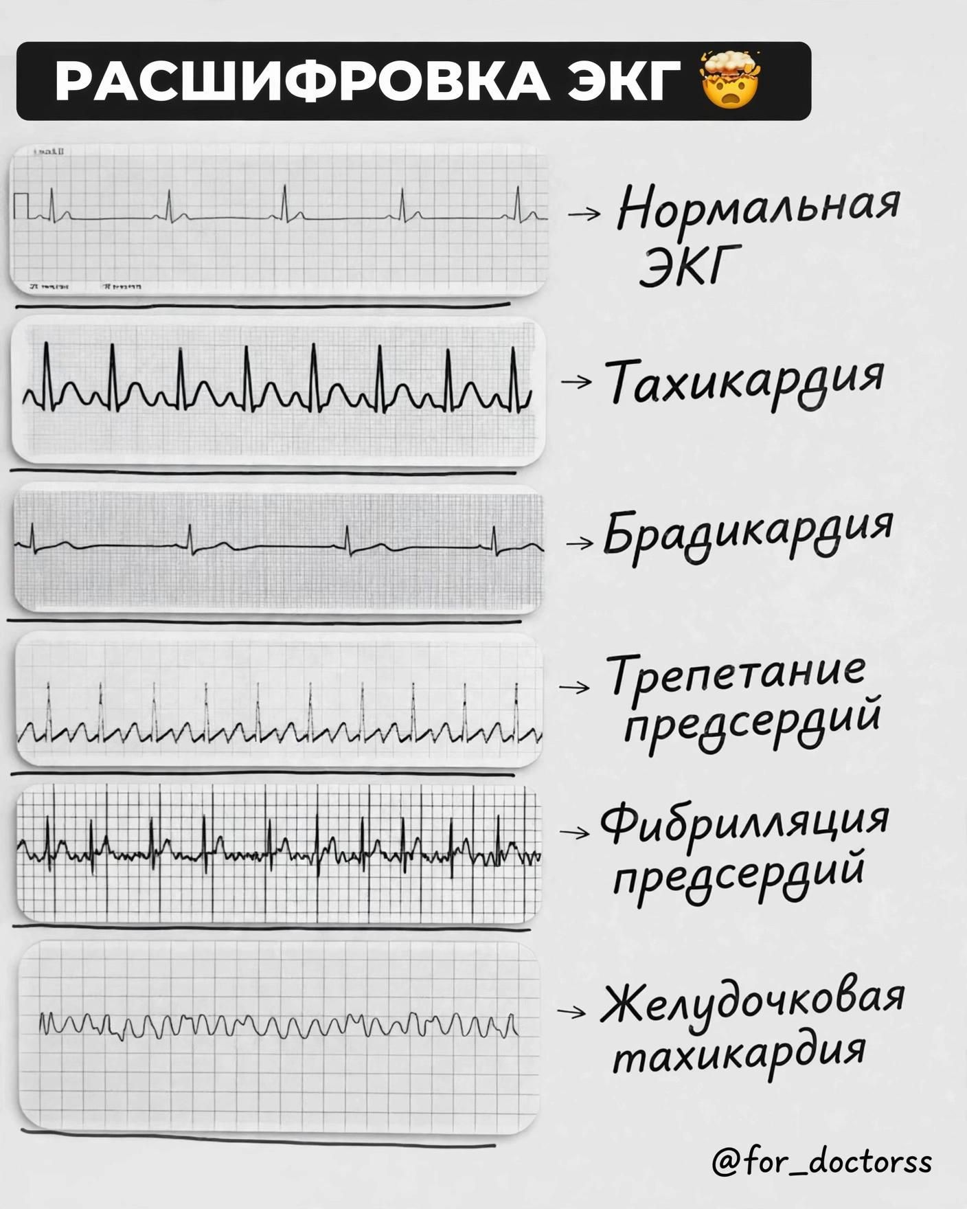 РАСШИФРОВКА ЭКГ 🤯 Нормальная ЭКГ Тахикардия Брадикардия Трепетание предсердий Фибрилляция предсердий Желудочковая тахикардия @for_doctorss