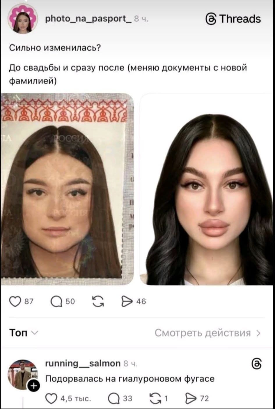 Сильно изменилась? До свадьбы и сразу после (меняю документы с новой фамилией). Подорвалась на гиалуроновом фугасе.