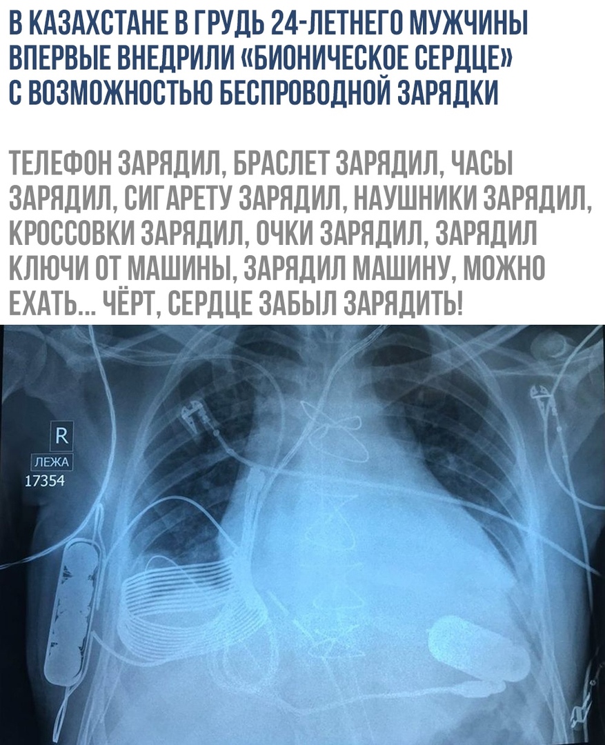 В КАЗАХСТАНЕ В ГРУДЬ 24 ЛЕТНЕГО МУЖЧИНЫ ВПЕРВЫЕ ВНЕДРИЛИ БИОНИЧЕОКОЕ СЕРДЦЕ ОВОЗМОЖНООТЬЮ БЕОПРОВОДНОИ ЗАРЯДКИ ТЕЛЕФОН 3АРНДИЛ БРАОЛЕТ 3АРЯДИЛ ЧАОЫ 3АРНДИЛ ОИГАРЕТУ 3АРЯДИЛ НАУШНИКИ ЗАРЯДИЛ КРООООВКИ ЗАРЯДИЛ ОЧКИ 3АРЯДИЛ ЗАРЯДИЛ КЛЮЧИ ОТ__МАШИНЫ ЗАРЯДИЛ МАШИНУ МОЖНО ЕХАТЬ ЧЕРТ СЕРДЦЕ ЗАБЫЛ ЗАРЯДИТЫ 17354