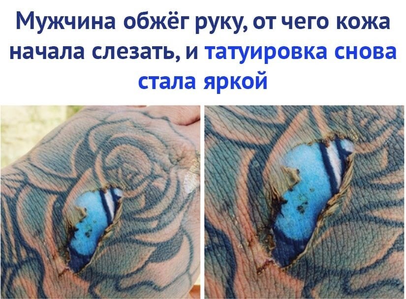 Мужчина обжёг руку от чего кожа начала слезать и татуировка снова стала яркой
