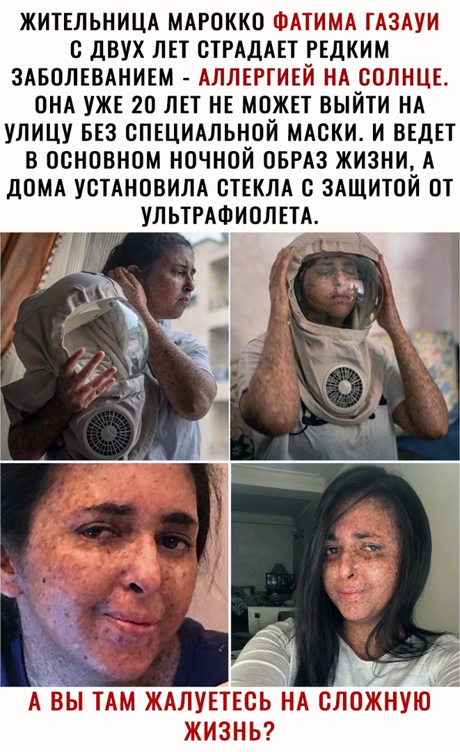 ЖИТЕЛЬНИЦА МАРОККО ФАТИМА ГАЗАУИ С ДВУХ ЛЕТ СТРАДАЕТ РЕДКИМ ЗАБОЛЕВАНИЕМ АЛЛЕРТИЕЙ НА СОЛНЦЕ ОНА УЖЕ 20 ЛЕТ НЕ МОЖЕТ ВЫЙТИ НА УЛИЦУ БЕЗ СПЕЦИАЛЬНОЙ МАСКИ И ВЕДЕТ В ОСНОВНОМ НОЧНОЙ ОБРАЗ ЖИЗНИ А ДОМА УСТАНОВИЛА СТЕКЛА С ЗАЩИТОЙ ОТ УЛЬТРАФИОЛЕТА А ВЬ ТАМ ЖАЛУЕТЕЁБ НА СЛОЖНУ ЖИЗНЬ