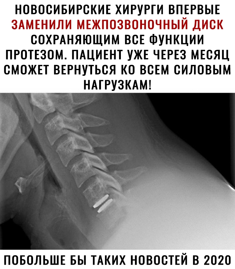 НОВОСИБИРСКИЕ ХИРУРГИ ВПЕРВЫЕ ЗАМЕНИЛИ МЕЖПОЗВОНОЧНЫЙ ДИСК СОХРАНЯЮЩИМ ВСЕ ФУНКЦИИ ПРОТЕЗОМ ПАЦИЕНТ УЖЕ ЧЕРЕЗ МЕСЯЦ СМОЖЕТ ВЕРНУТЬСЯ КО ВСЕМ СИЛОВЫМ НАТРУЗКАМ ПОБОЛЬШЕ БЫ ТАКИХ НОВОСТЕЙ В 2020