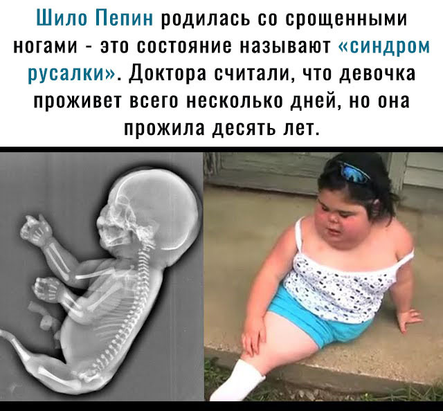 Шило Пепин родилась со срощенными нотами это состояние называют синдром русалки Доктора считали что девочка проживет всего несколько дней но она прожила десять лет