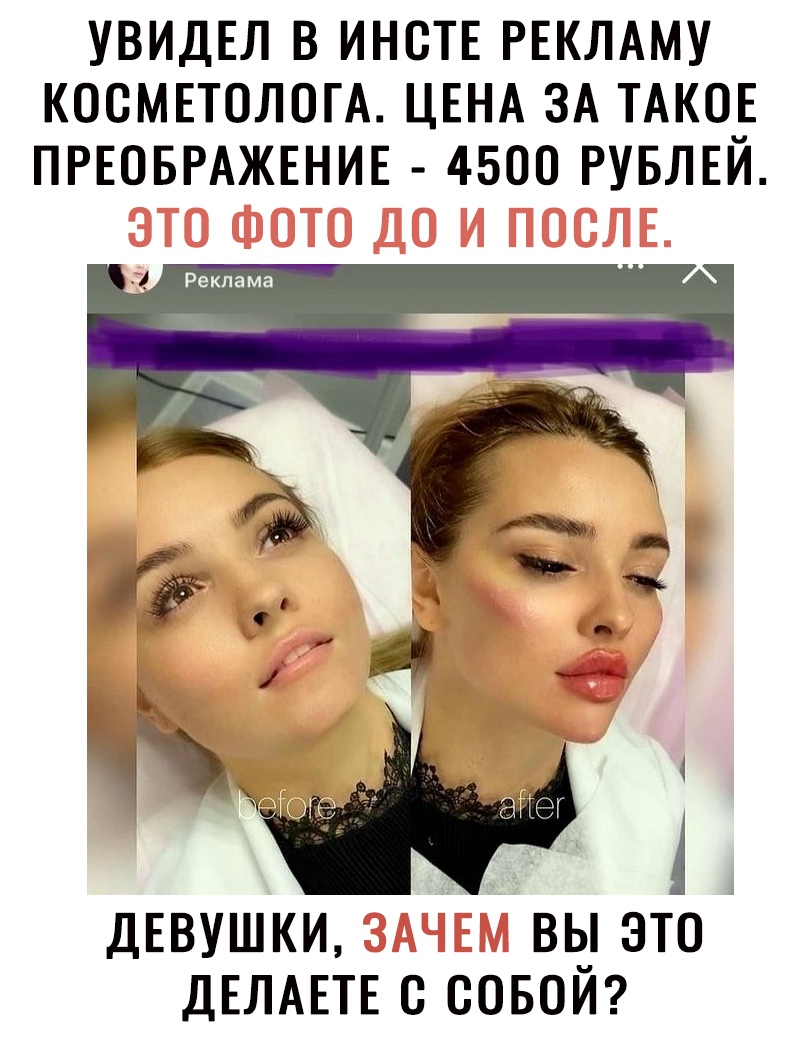 УВИДЕЛ В ИНСТЕ РЕКЛАМУ КОСМЕТОЛОГА ЦЕНА ЗА ТАКОЕ ПРЕОБРАЖЕНИЕ 4500 РУБЛЕИ 1 ДЕВУШКИ вы это ДЕЛАЕТЕ совем