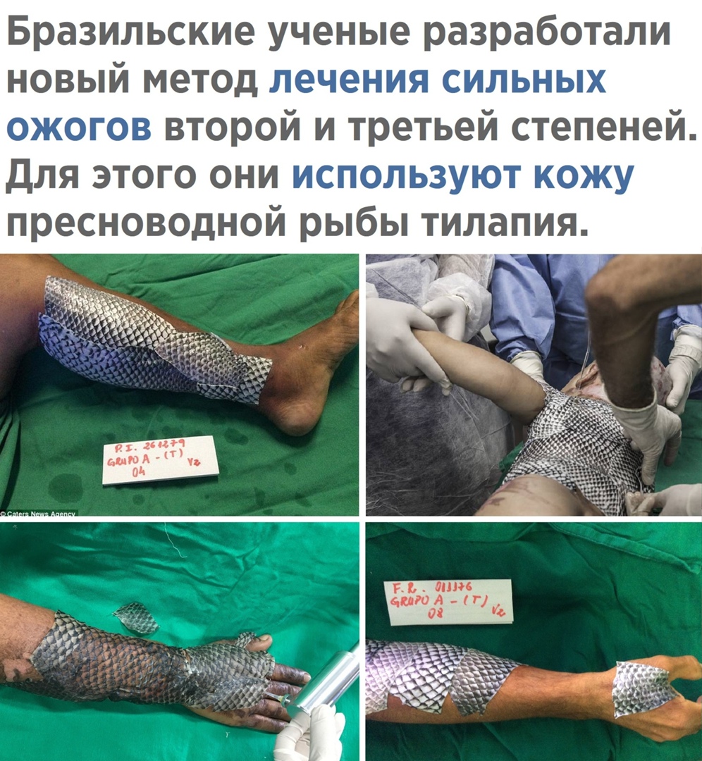 Бразильские ученые разработали новый метод лечения сильных ожогов второй и третьей степеней Для этого они используют кожу пресноводной рыбы тилапия г пюл у