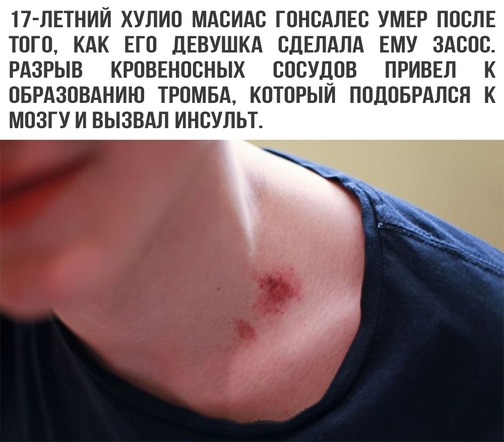 17 ЛЕТНИЙ ХУЛИО МАОИАО ГОНОАЛЕО УМЕР ПОСЛЕ ТОГО КАК ЕГО ДЕВУШКА ОДЕЛАЛА ЕМУ ЗАООО РАЗРЫВ КРОВЕНООНЫХ СОСУДОВ ПРИВЕЛ К ОБРАЗОВАНИЮ ТРОМБА КОТОРЫИ ПОДОБРАЛОЯ К МОЗГУ И ВЫЗВАЛ ИНОУЛЬТ