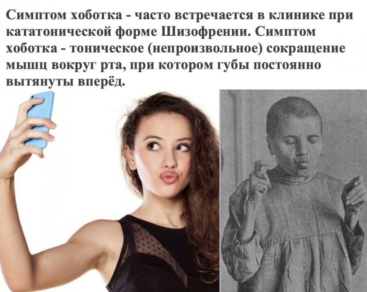 Симптом хоботка часто встречается в клинике при кататонической форме Шизофрении Симптом хоботка тоническое непроизвольное сокращение мышц вокруг рта при котором губы постоянно вытянуты вперёд