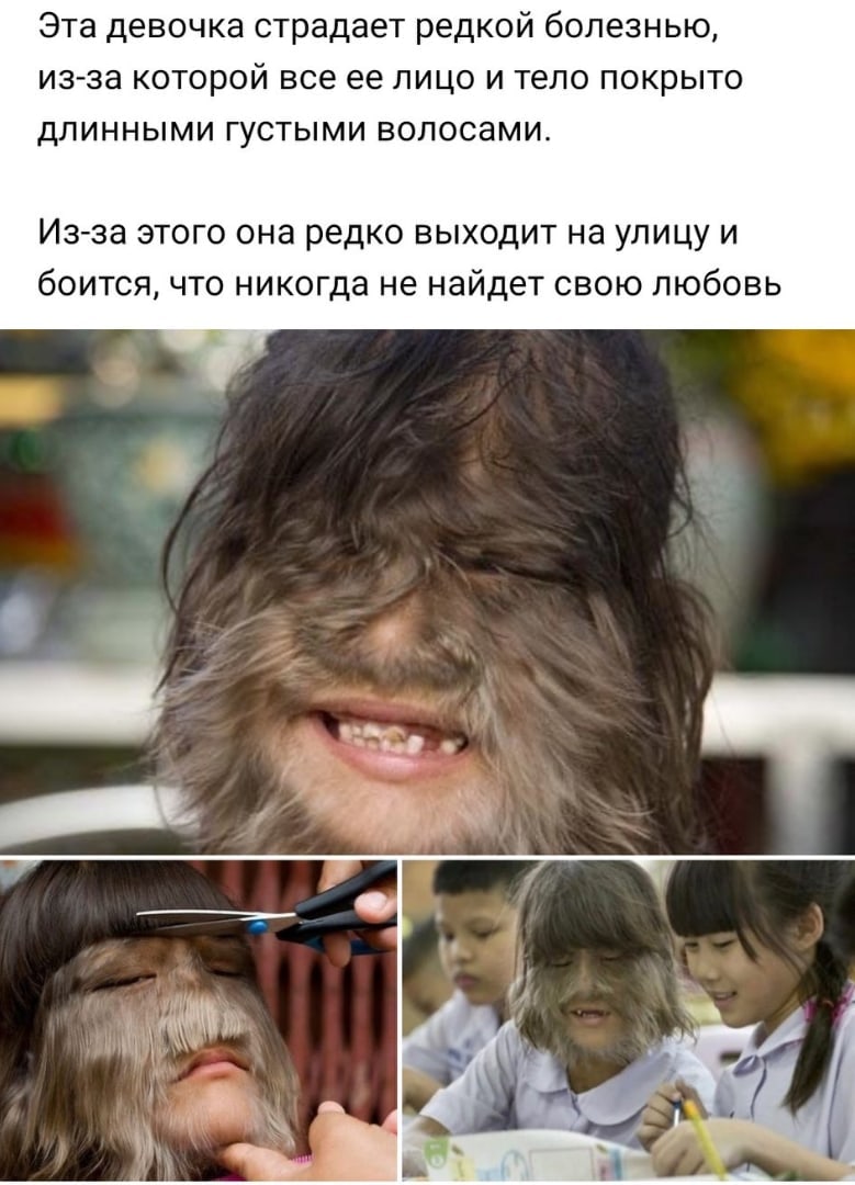 Эта девочка страдает редкой болезнью изза КОТОРОЙ все ее ЛИЦО И тело ПОКРЫТО ДЛИННЫМИ ГУСТЫМИ ВОЛОСЭМИ Изза этого она редко выходит на улицу и боится что никогда не найдет свою любовь