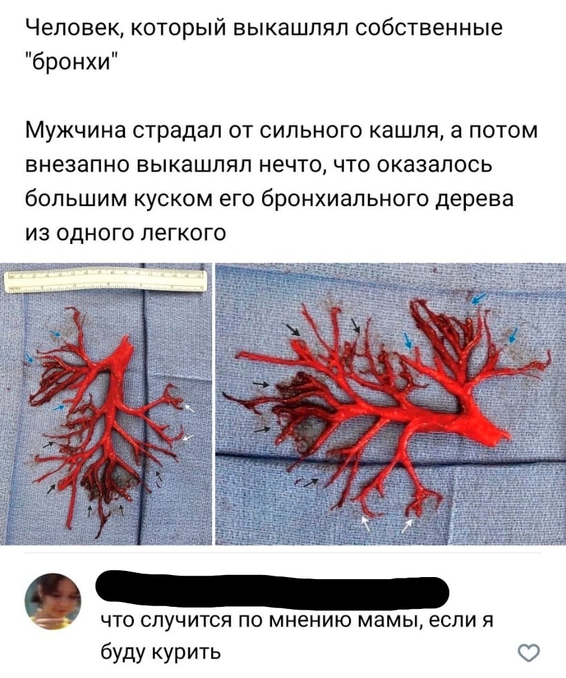 Человек который выкашлял собственные бронхи МУЖЧИНЭ страдал ОТ СИЛЬНОГО КдШЛЯ а ПОТОМ внезапно ВЫКЭШЛЯЛ НЕЧТО ЧТО ОКЗЗЭЛОСЬ бОПЬШИМ КУСКОМ ЭГО бронхиального дерева ИЗ ОДНОГО ЛЕГКОГО что случится по мнению мамы если я буду курить