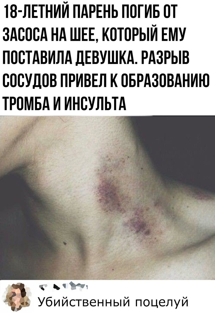 18 ЛЕТНИЙ ПАРЕНЬ ПОГИБ ОТ ЗАОООА НА ШЕЕ КОТОРЫЙ ЕМУ ПООТАВИЛА дЕВУШКА РАЗРЫВ ОООУДОВ ПРИВЕЛ К ОБРАЗОВАНИЮ ТРОМБА И ИНОУЛЬТА Убийственный поцелуй