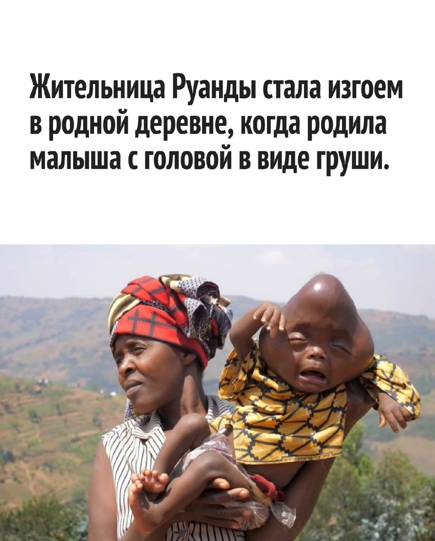 Жительница Руанды стала изгоем в родной деревне когда родила малыша головой в виде груши