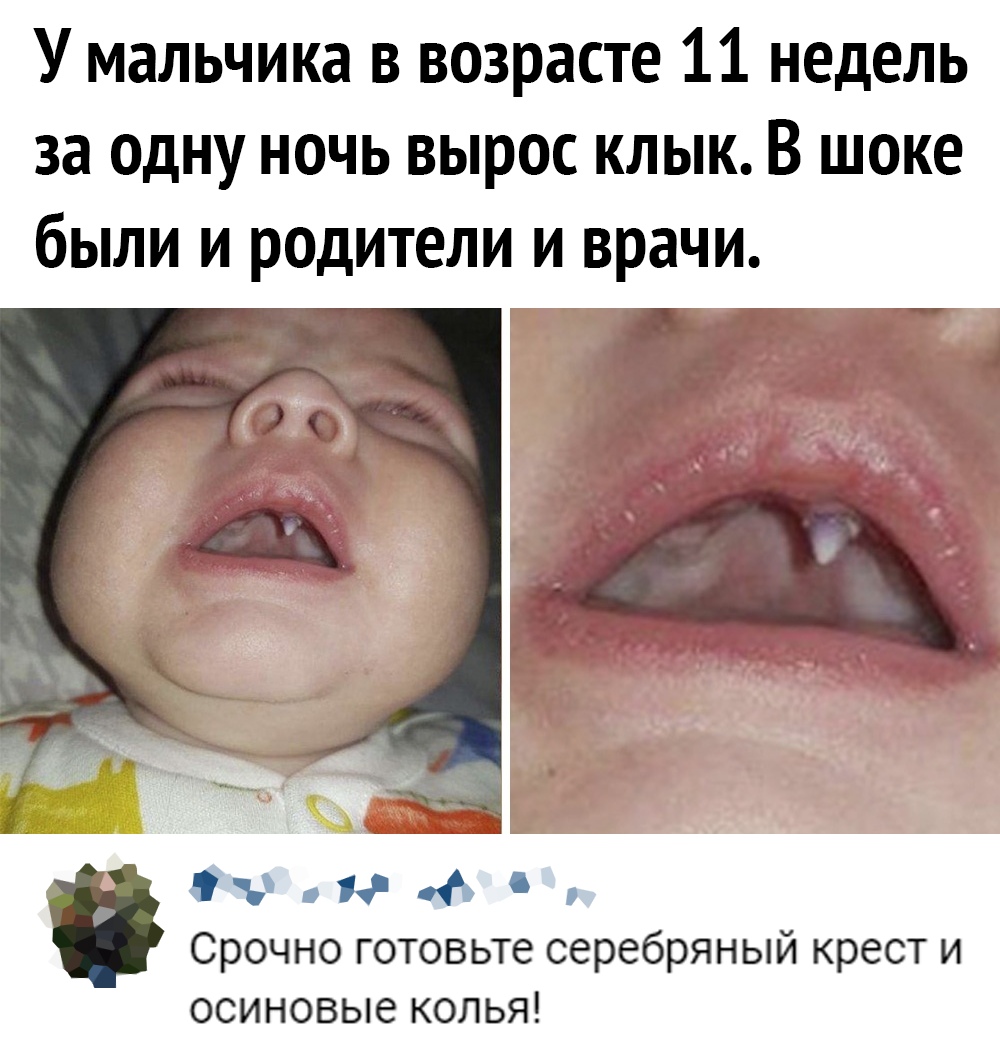 У мальчика в возрасте 11 недель за одну ночь вырос клык В шоке были и родители и врачи Ку _ _ рт чъ о 06 Срочно готовьте серебряный крест и осиновые колья