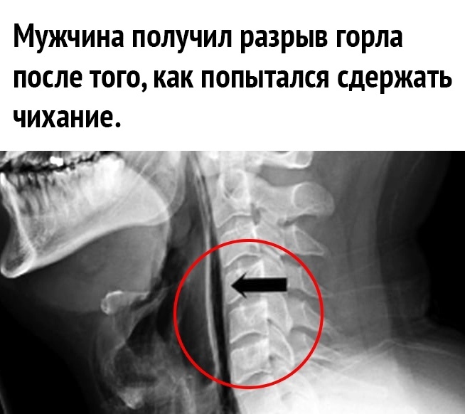 Мужчина получил разрыв горла после того как попытался сдержать чихание ти _