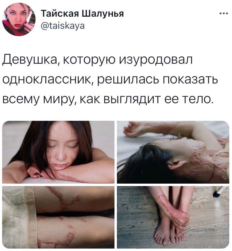 а ён Таиская Шалунья таі5Кауа Девушка которую изуродовал одноклассник решилась показать всему миру как выглядит ее тело