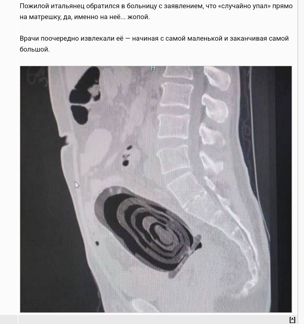Пожилой итальянец обратился в больницу с заявлением что случайно упал прямо на матрешку даименно на неё жотой Врачи поочередко извлекали е8 начиная самой маленькой и заканчивая самой большой