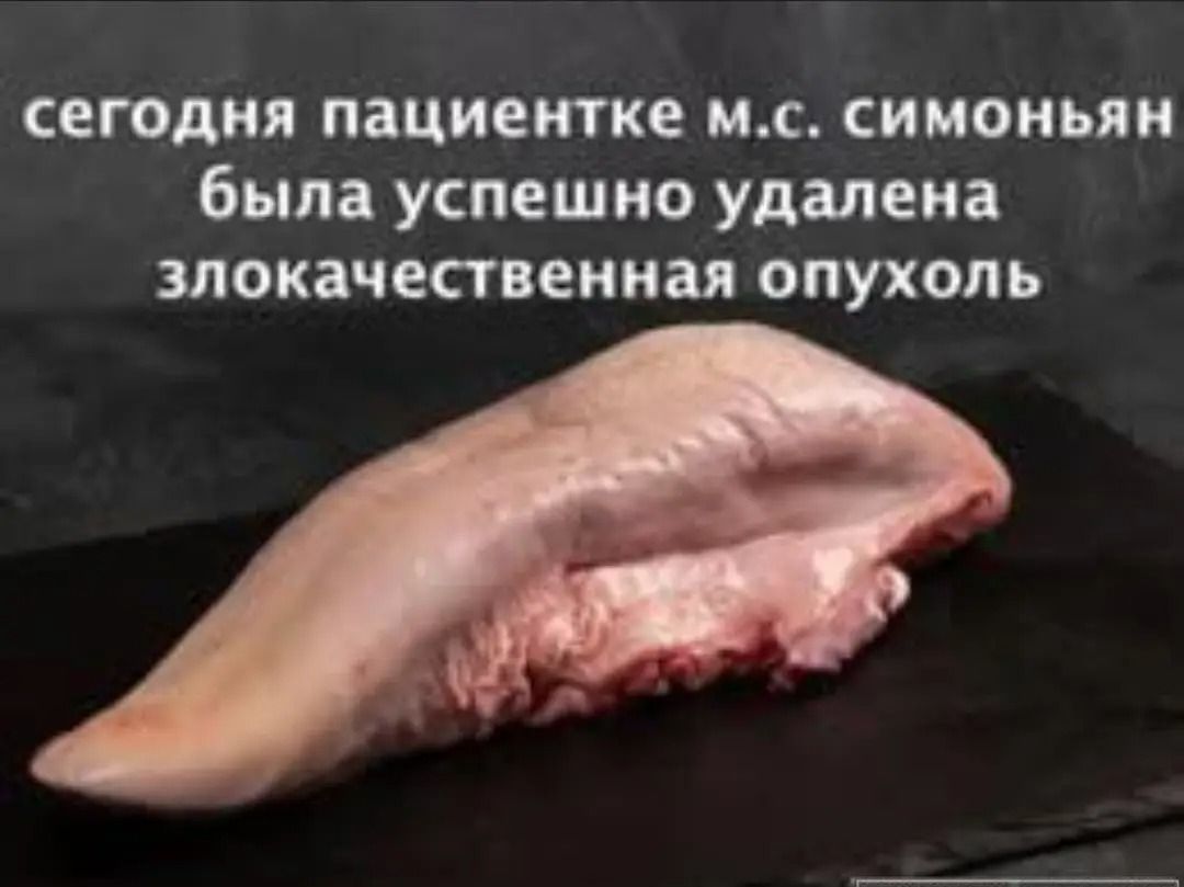 сегодня пациентке м.с. симоньян была успешно удалена злокачественная опухоль