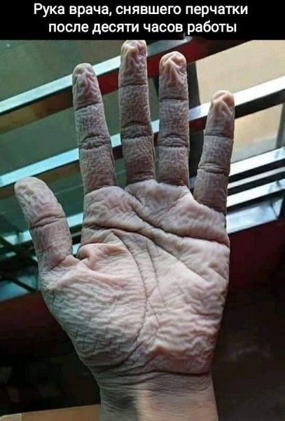 Рука врача снявшего перчатки после десяти часов работы