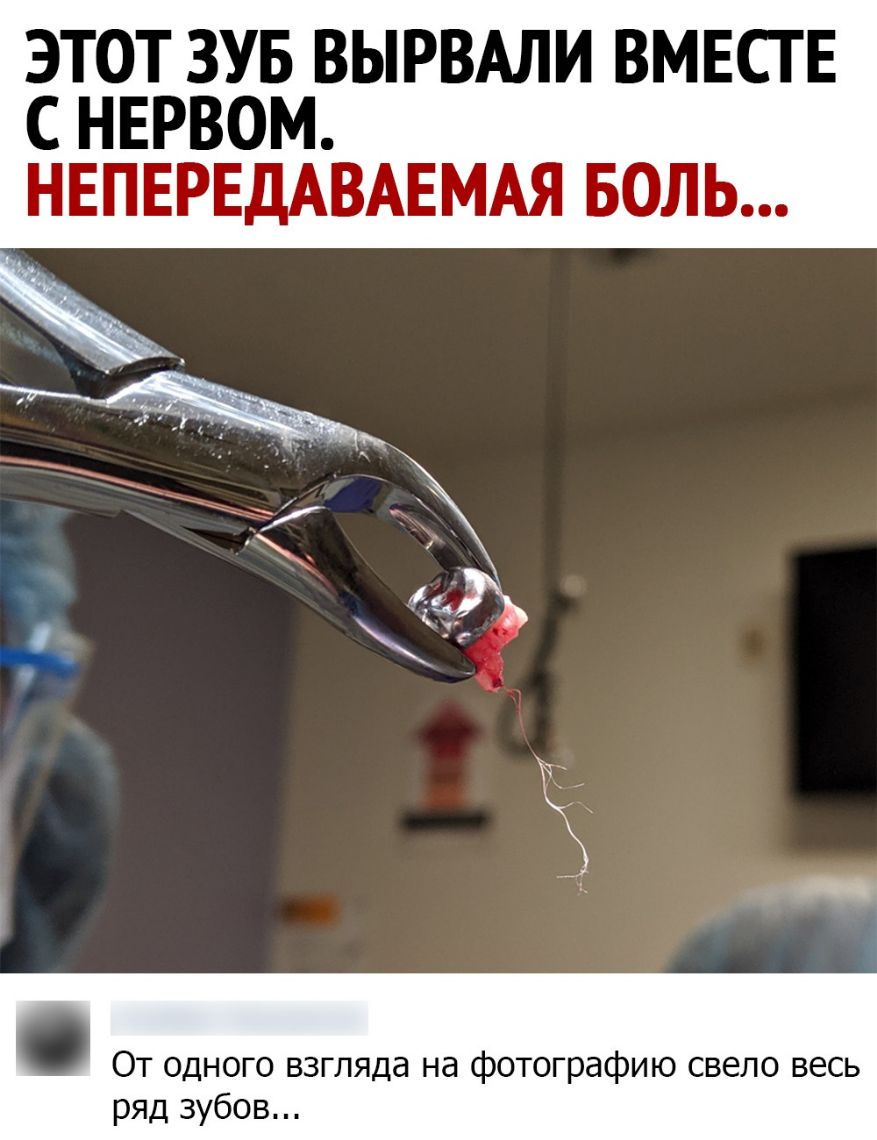 ЭТОТ ЗУБ ВЫРВАЛИ ВМЕСТЕ С НЕРВОМ НЕПЕРЕДАВАЕМАЯ БОЛЬ От одного взгляда на фотографию свело весь ряд зубов