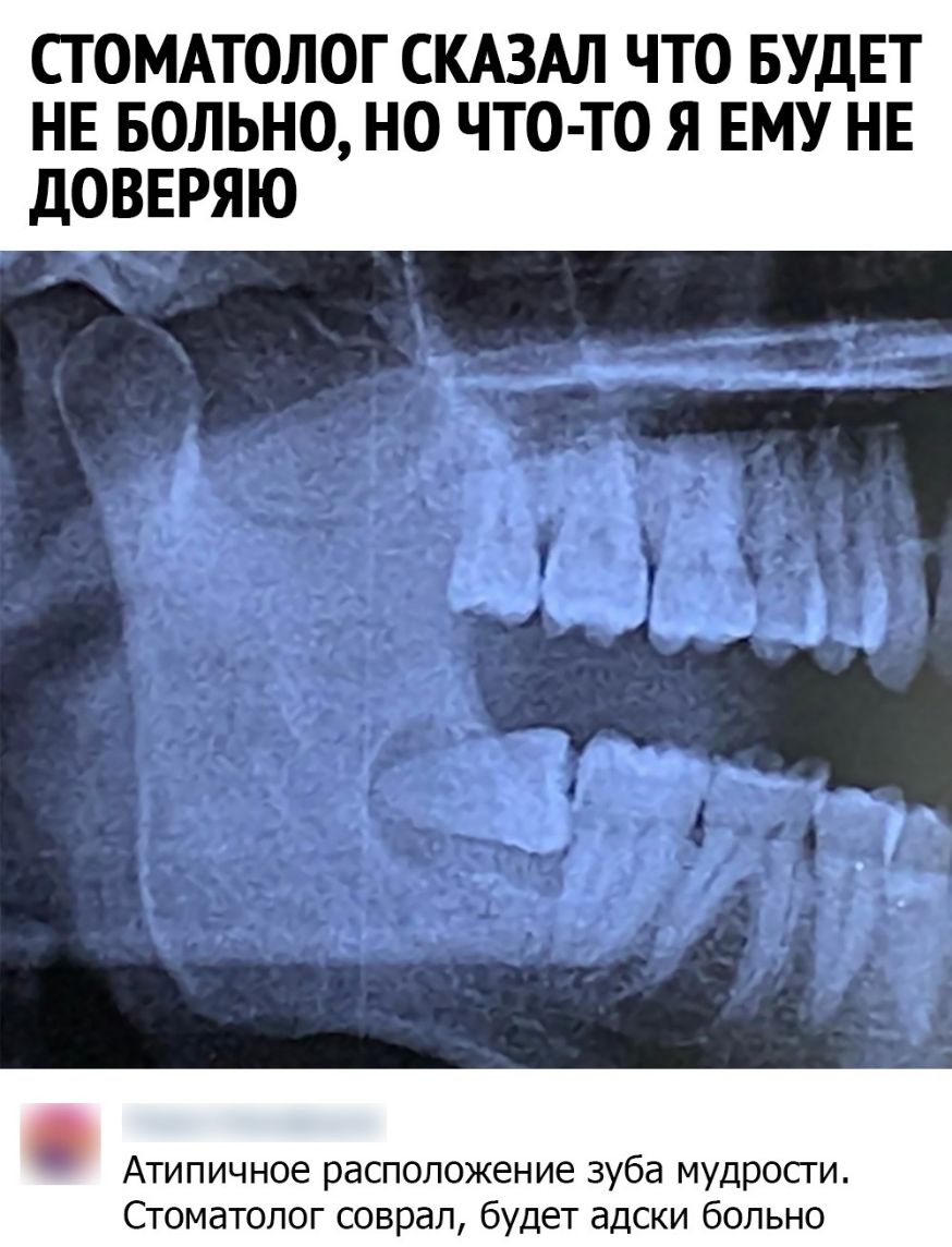 СТОМАТОЛОГ СКАЗАЛ ЧТО БУДЕТ НЕ БОЛЬНО НО ЧТО ТО Я ЕМУ НЕ дОВЕРЯЮ Атипичное расположение зуба мудросги Стоматолог соврал будет адски больно