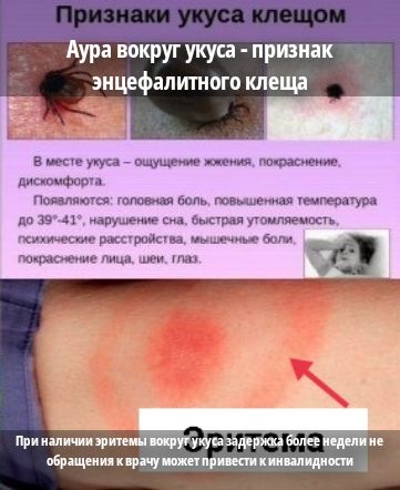 Признаки укуса клещом. Аура вокруг укуса - признак энцефалитного клеща. В месте укуса – ощущение жжения, покраснение, дискомфорт. Появляется: головная боль, повышенная температура до 39–41°C, нарушение сна, быстрая утомляемость, психические расстройства, мышечные боли, покраснение лица, шеи, глаз. При наличии эритемы вокруг укуса задержка более недели может привести к инвалидности.
