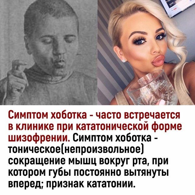Симптом хоботка - часто встречается в клинике при кататонической форме шизофрении. Симптом хоботка - тоническое (непроизвольное) сокращение мышц вокруг рта, при котором губы постоянно вытянуты вперед; признак кататонии.