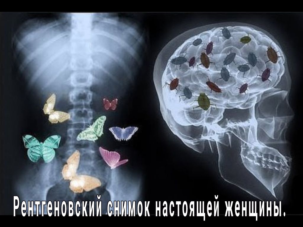 Рентгкеновскии АСНИМОК НЗСТОЯЩЭИ женщины