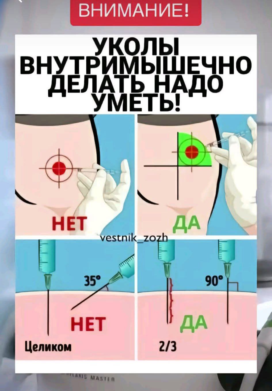 УКОЛЫ ВНУТРИМЫШЕЧЕНО ДЕЛАТЬ НУУ НУМЕТЬ! НЕТ / ДА; 35°; 90°; Целиком; 2/3