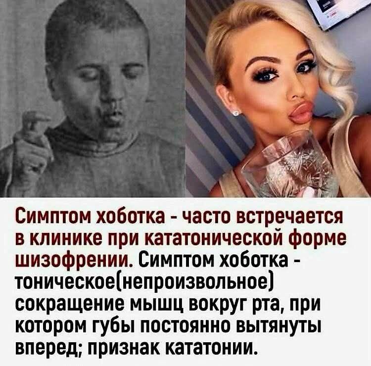 Симптом хоботка - часто встречается в клинике при кататонической форме шизофрении. Симптом хоботка - тонческое (непроизвольное) сокращение мышц вокруг рта, при котором губы постоянно вытянуты вперед; признак кататонии.