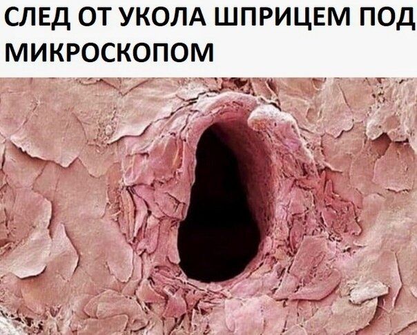 СЛЕД ОТ УКОЛА ШПРИЦЕМ ПОД