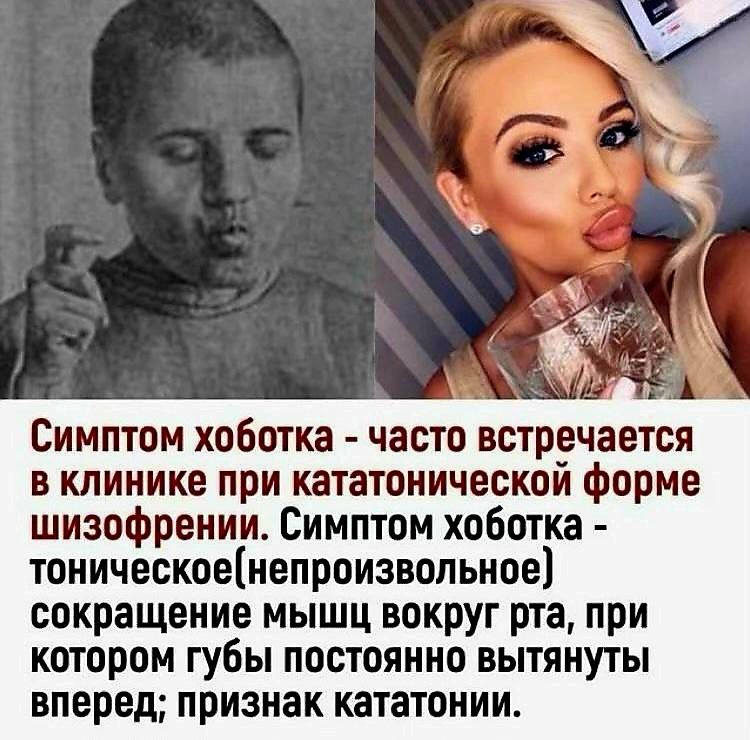 Симптом хоботка - часто встречается в клинике при кататонической форме шизофрении. Симптом хоботка - тоническое (непроизвольное) сокращение мышц вокруг рта, при котором губы постоянно вытянуты вперед; признак кататонии.