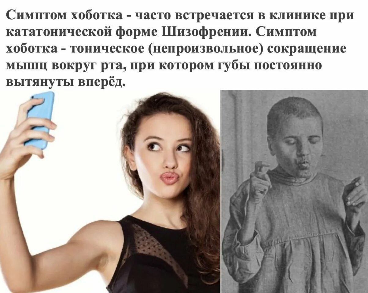 Симптом хоботка - часто встречается в клинике при кататонической форме Шизофрении. Симптом хоботка - тоническое (непроизвольное) сокращение мышц вокруг рта, при котором губы постоянно вытянуты вперёд.