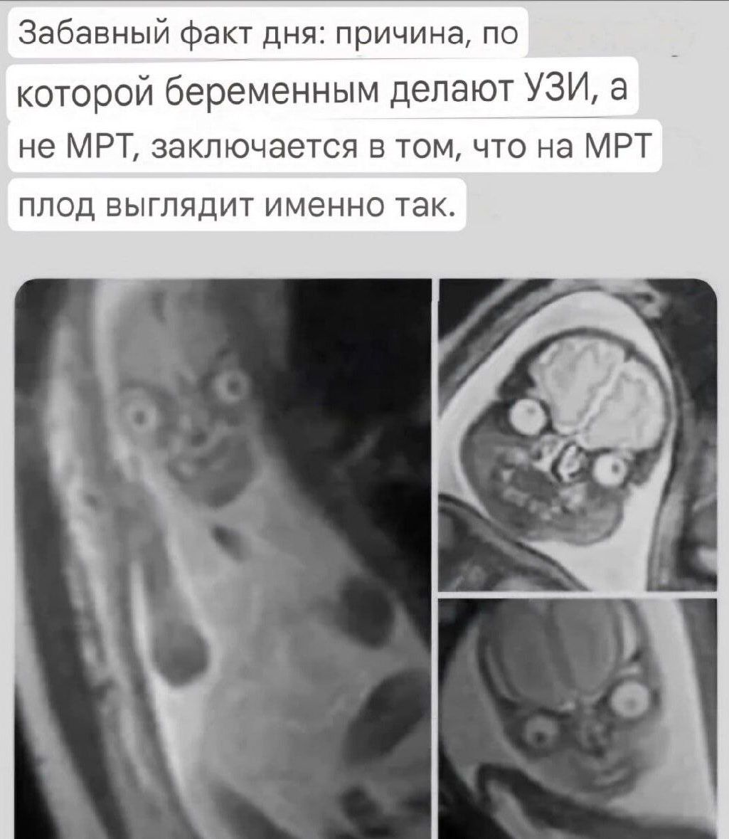 Забавный факт дня: причина, по которой беременным делают УЗИ, а не МРТ, заключается в том, что на МРТ плод выглядит именно так.