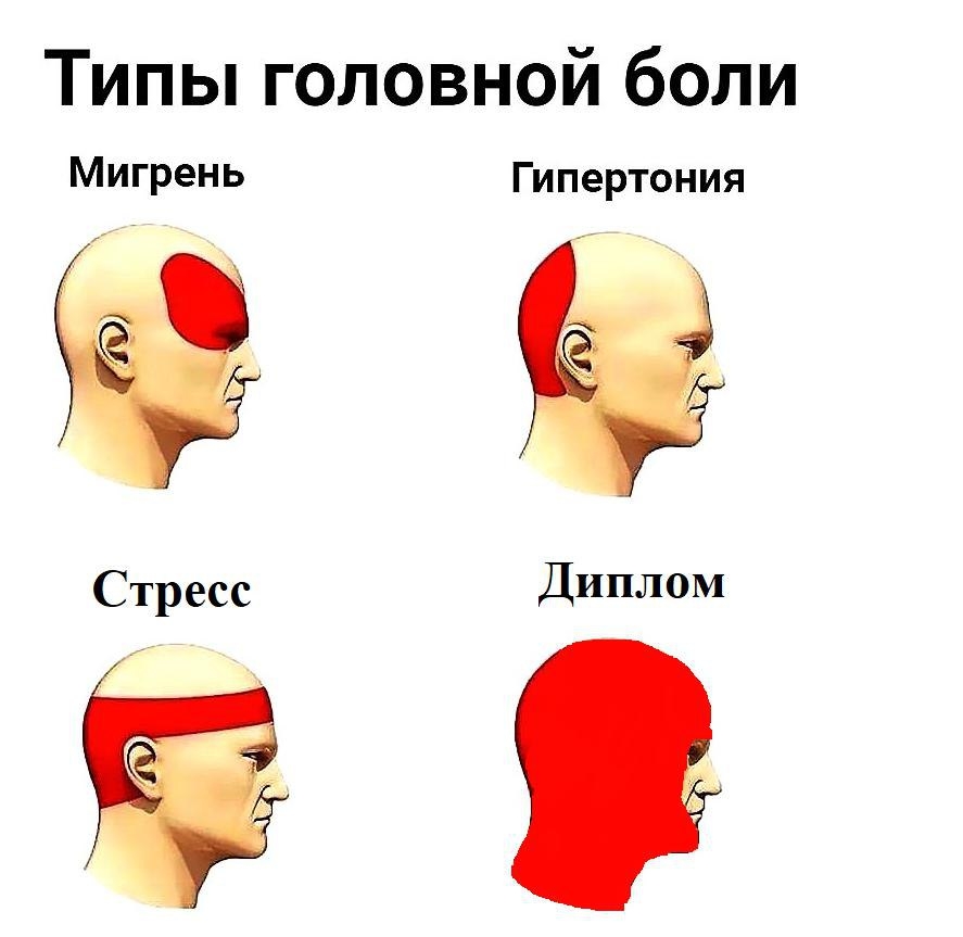 Типы головной боли Мигрень Гипертония