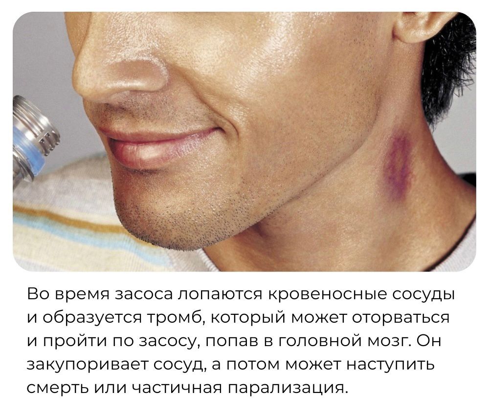 Во время засоса лопаются кровеносные сосуды и образуется трома который может оторваться и пройти по завесу попав в головной мозг Он закупоривает сосуд а потом может наступить смерть или частичная парапизеция