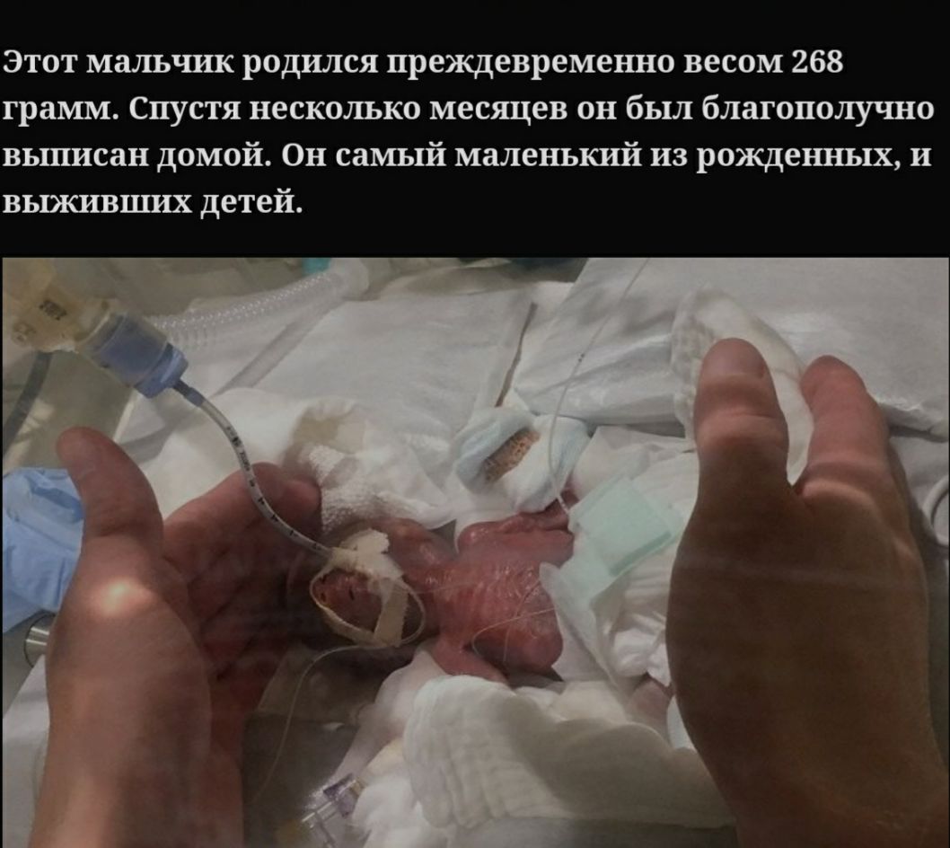 Этот мальчик родился преждевременно весом 268 грамм Спустя несколько месяцев он был благополучно вьшисан домой Он самый маленъкші из рожденных и выживцшх детей