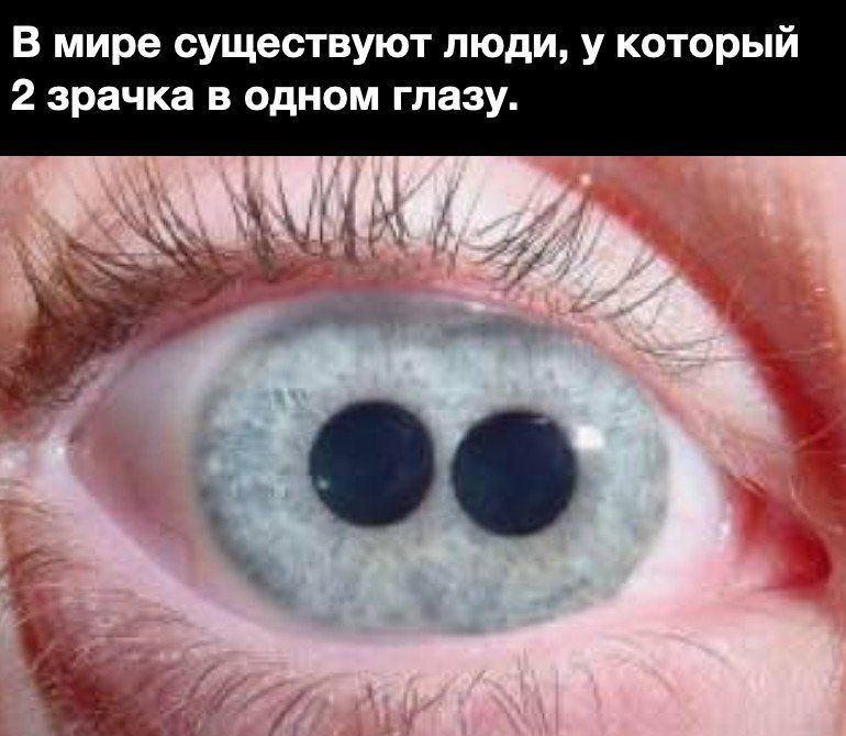 В мире существуют люди у который 2 зрачка в одном глазу