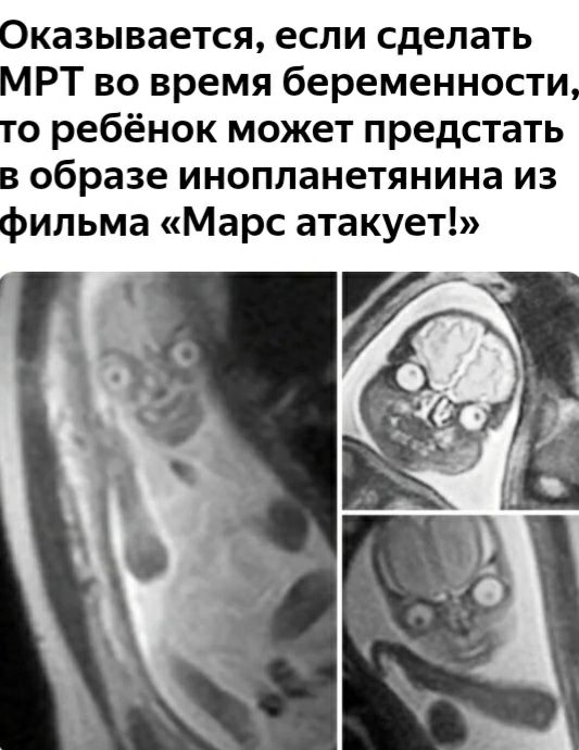 казывается если сделать РТ во время беременности 0 ребёнок может предстать образе инопланетянина из ильма Марс атакует