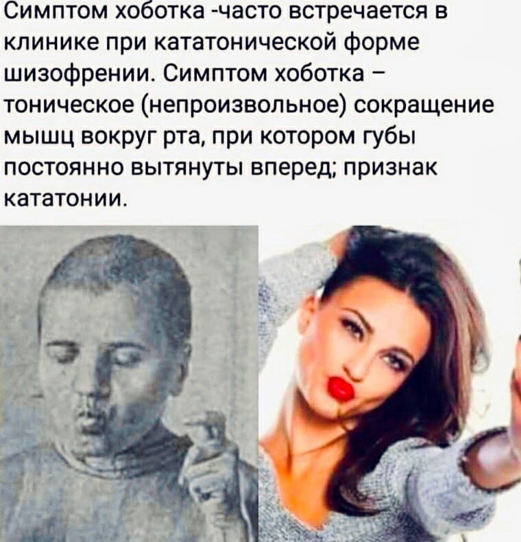 Симптом хоботка часто встречается в клинике при кататонической форме шизофрении Симптом хоботка тоническое непроизвольное сокращение мышц вокруг рта при котором губы постоянно вытянуты вперед признак кататонии