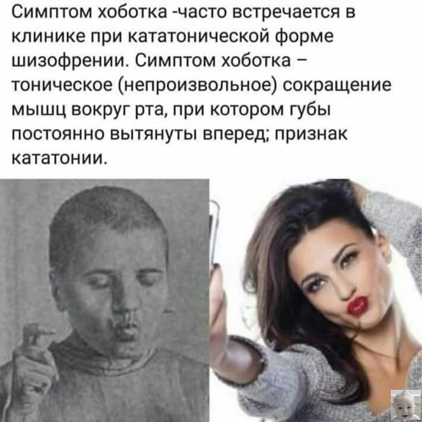 Симптом хоботка часто встречается в клинике при кататонической форме шизофрении Симптом хоботка тоническое непроизвольное сокращение мышц вокруг рта при котором губы постоянно вытянуты вперед признак кататонии