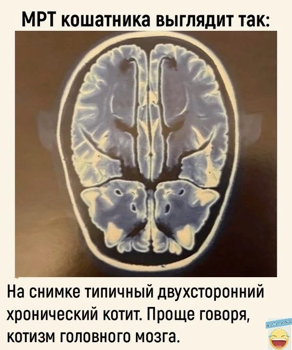 МРТ кошатника выглядит так На снимке типичный двухсторонний хронический котит Проще говоря котизм головного мозга