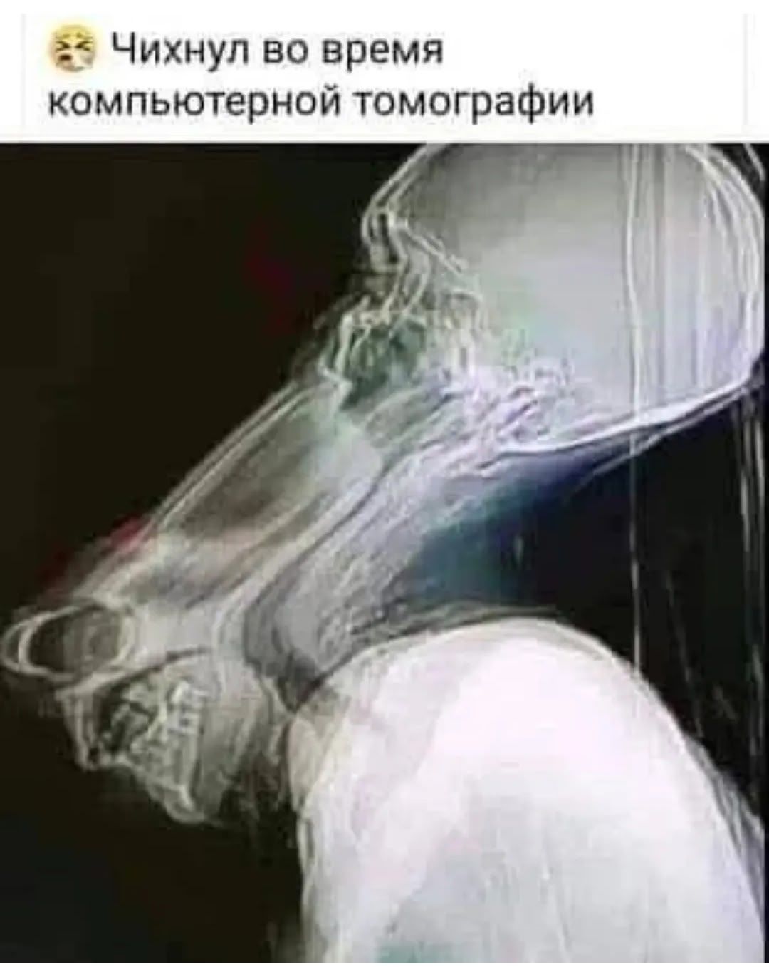 Чихнул во время компьютерной томографии