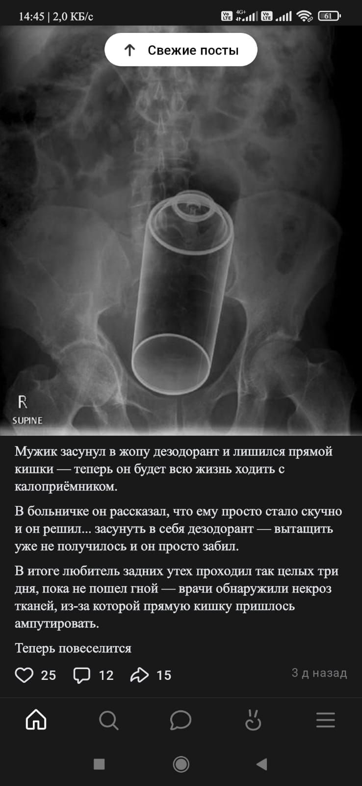 Мужик засунул в копу дезодорат и лишился прямой кишки — теперь он будет всю жизнь ходить с калорированником.

В больнице он рассказывал, что ему просто стало скучно и он решил... засунуть в себя дезодорат — вытащить уже не получилось и он просто забыл.

В итоге любитель задних утех проходил так целых три дня, пока не попёр гной — врачи обнаружили некроз тканей, из-за которой прямую кишку пришлось ампутировать.

Теперь повеселится.