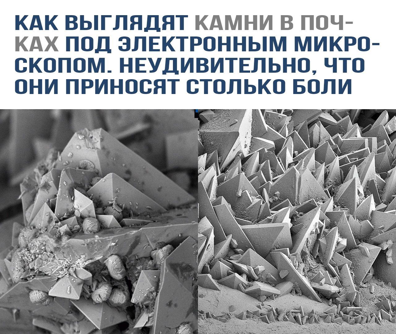 КАК ВЫГЛЯДЯТ КАМНИ В ПОЧКАХ ПОД ЭЛЕКТРОННЫМ МИКРОСКОПОМ. НЕУДИВИТЕЛЬНО, ЧТО ОНИ ПРИНОСЯТ СТОЛЬКО БОЛИ