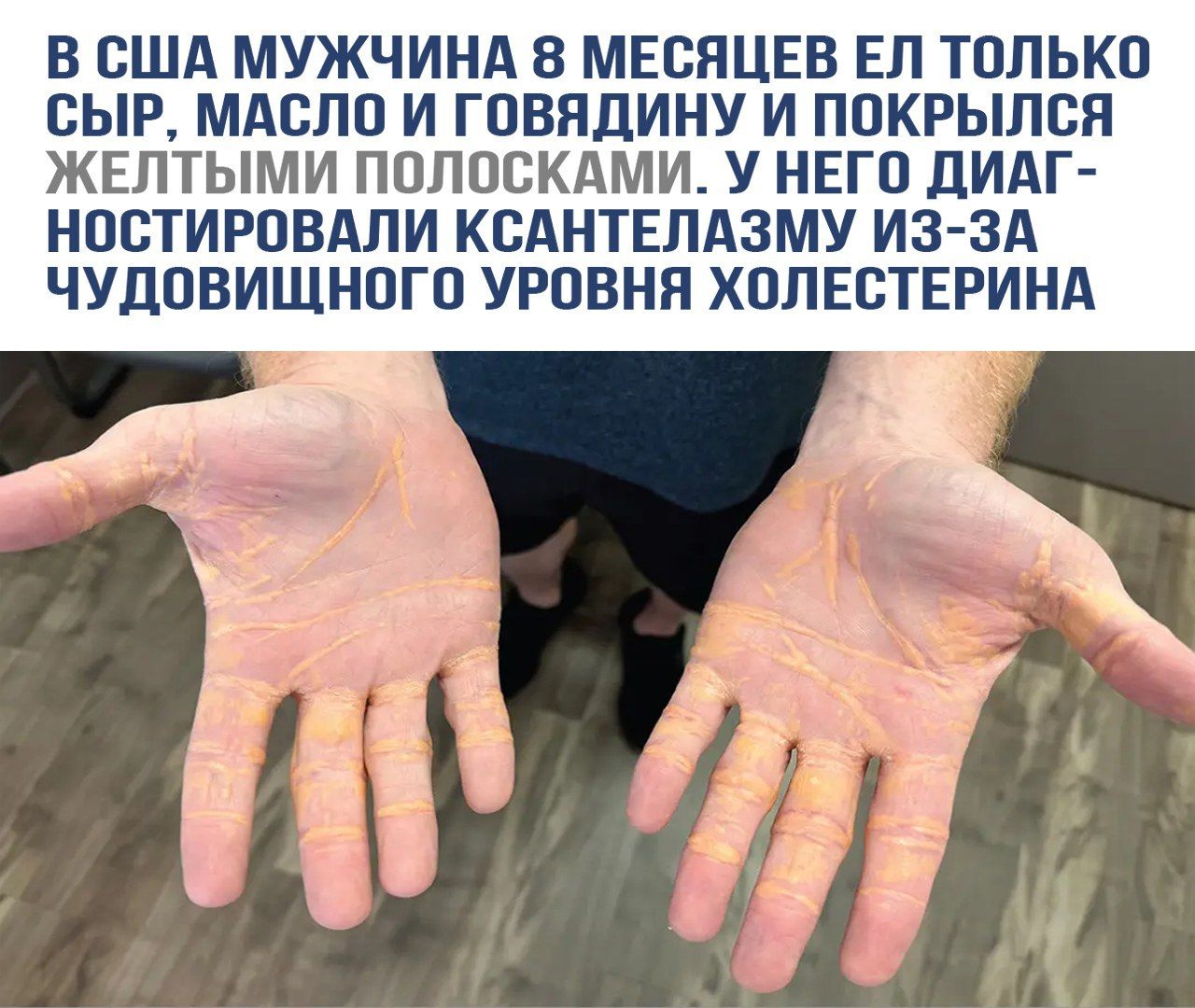 В США мужчина 8 месяцев ел только сыр, масло и говядину и покрылся желтыми полосками. У него диагностировали ксантомазу из-за чудовищного уровня холестерина.