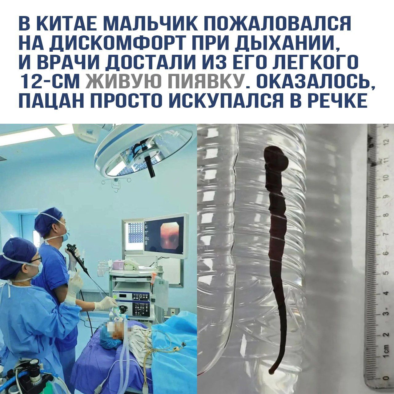 В Китае мальчик пожаловался на дискомфорт при дыхании, и врачи достали из его легкого 12-см живую пиявку. Оказалось, пацан просто искупался в речке.