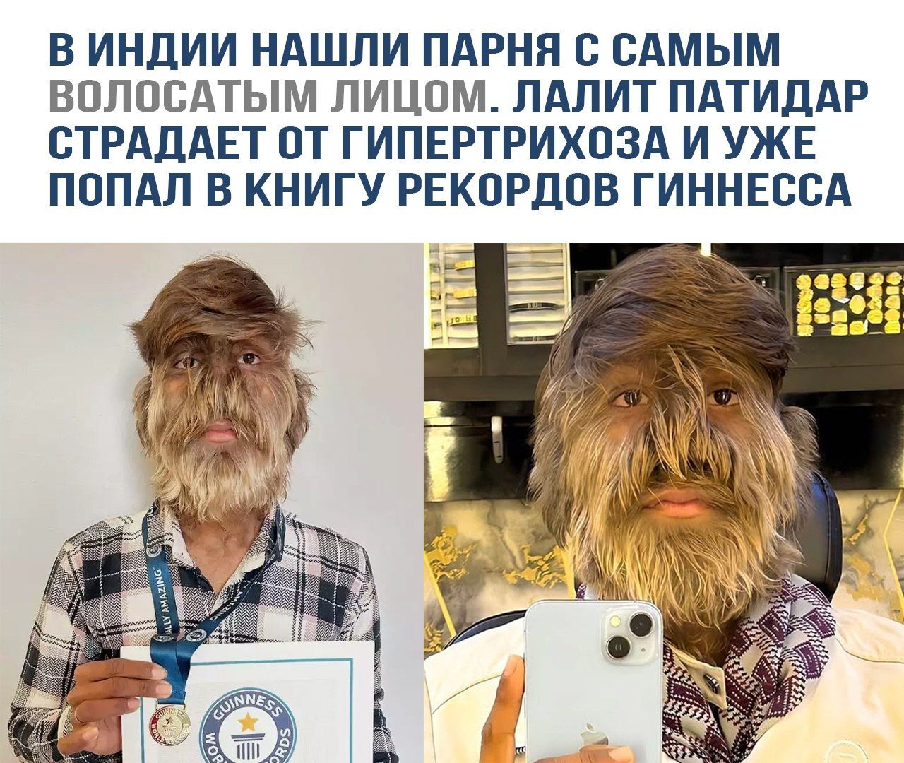 В Индии нашли парня с самым волосатым лицом. Лалит Патидар страдает от гипертрихоза и уже попал в книгу рекордов Гиннесса.