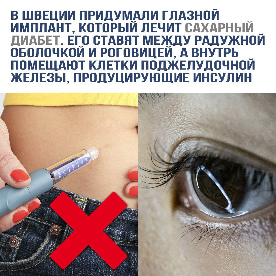 В Швеции придумали глазной имплант, который лечит сахарный диабет. Его ставят между радужной оболочкой и роговицей, а внутрь помещают клетки поджелудочной железы, производящие инсулин.
