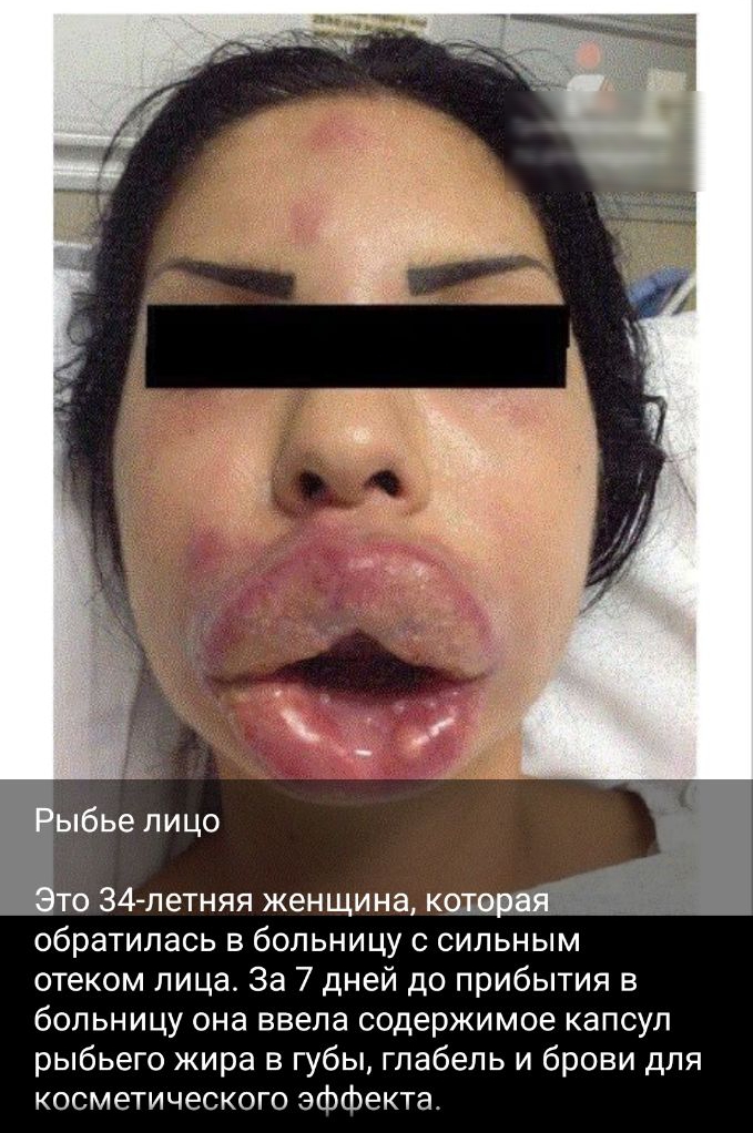 то 34 летняя женщина которй ЁЁ обратилась в больницу с сильным отеком лица За 7 дней до прибытия в больницу она ввела содержимое капсул рыбьего жира в губы глабель и брови для косметического эффекта