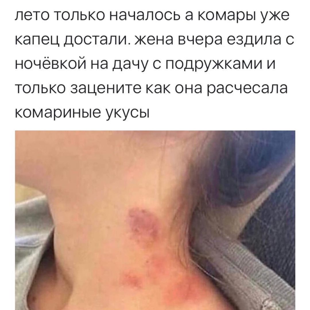 пето только началось а комары уке капец достали жена вчера ездила с ночёвкой на дачу с ПОДРУжками и только зацените как она расчесапа комариные укусы