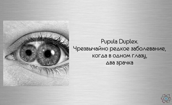 Ририіа Виріех Чрезвычайно редкое эаБОАгваниг кома в одном ГАазч Ава зрачка
